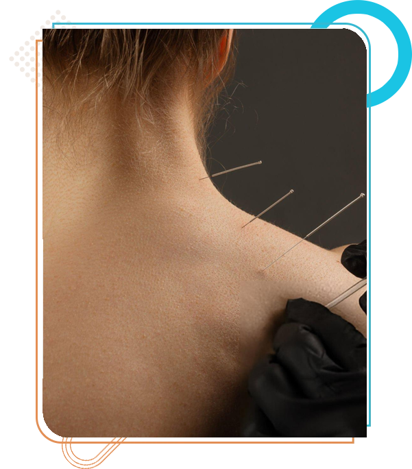 medical acupuncture